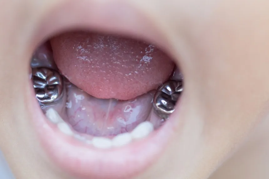 Why Do Kids Get Silver Teeth? Causes, Treatments, & Prevention